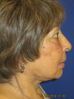 Face & Neck Rejuvenation