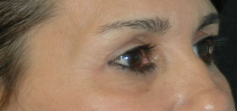 Eye Brow & Forehead Enhancement