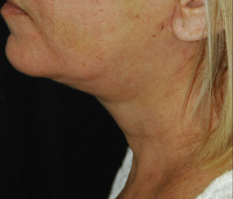 Chin Augmentation Results Fort Lauderdale