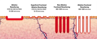 Fractional CO2 Laser Illustration