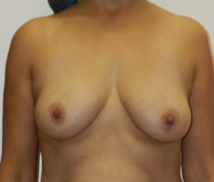 Breast Augmentation Surgery Results Fort Lauderdale