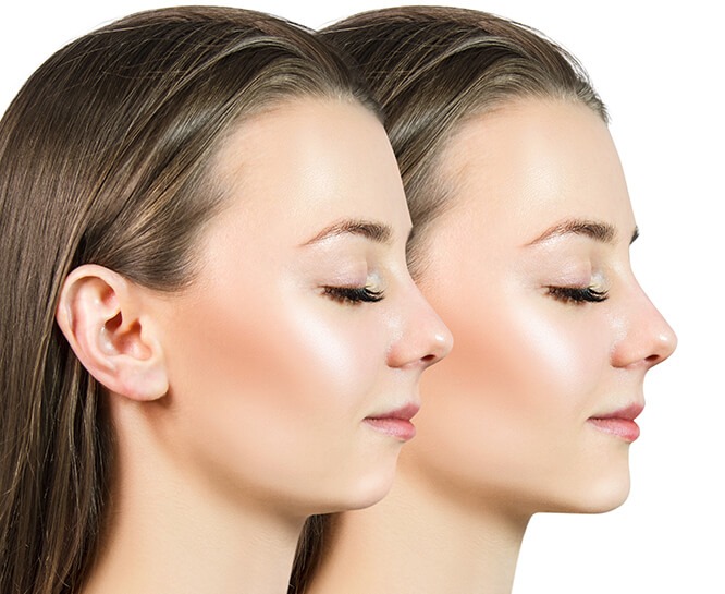 Chin Augmentation Procedure Fort Lauderdale