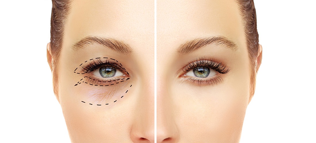 Blepharoplasty Before and After Procedure with markings