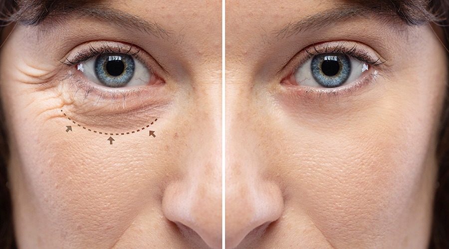 Lower Eyelid Lift Procedure with marks